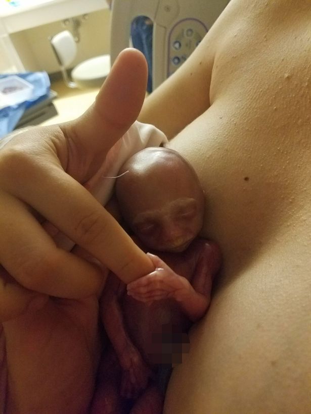 罕見病女嬰緊握媽媽手指道別