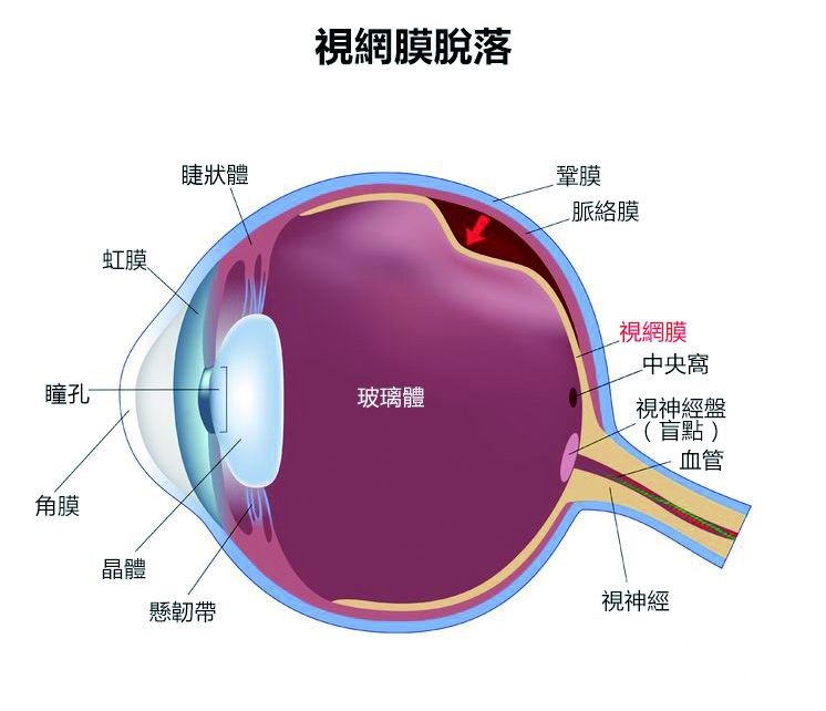 小心視網膜變薄脫落