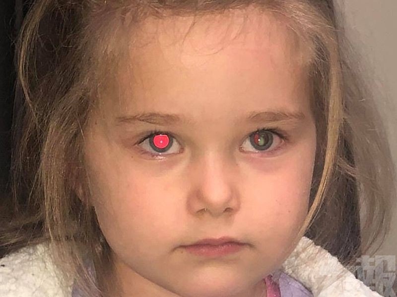 澳洲4歲女被揭發罹患眼癌​