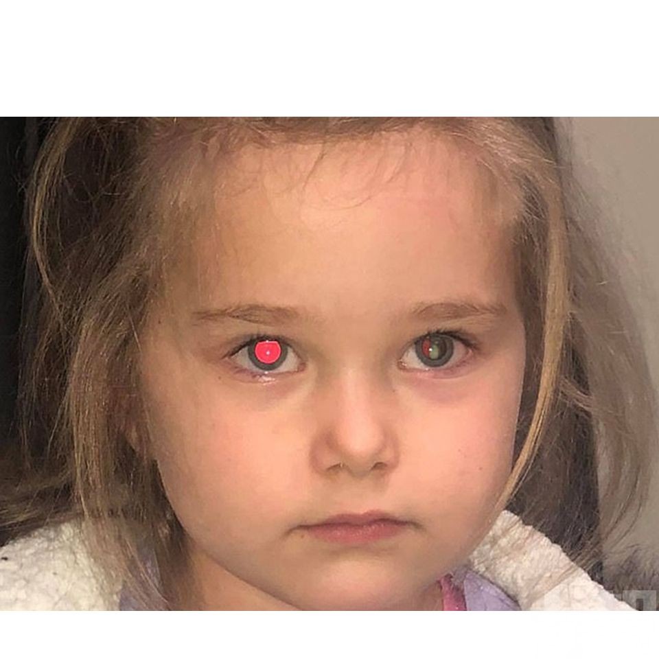 澳洲4歲女被揭發罹患眼癌​