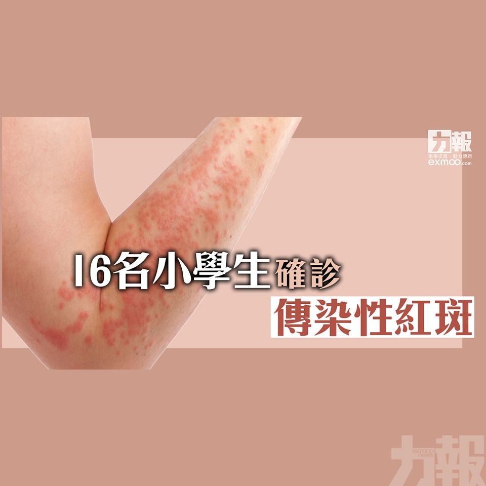 16名小學生確診傳染性紅斑