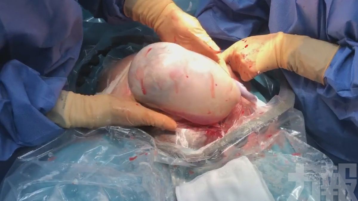 西班牙雙胞胎女嬰包著羊膜囊出生