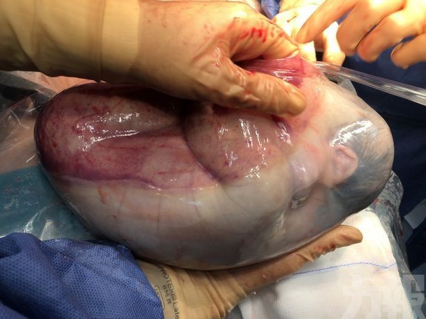 西班牙雙胞胎女嬰包著羊膜囊出生