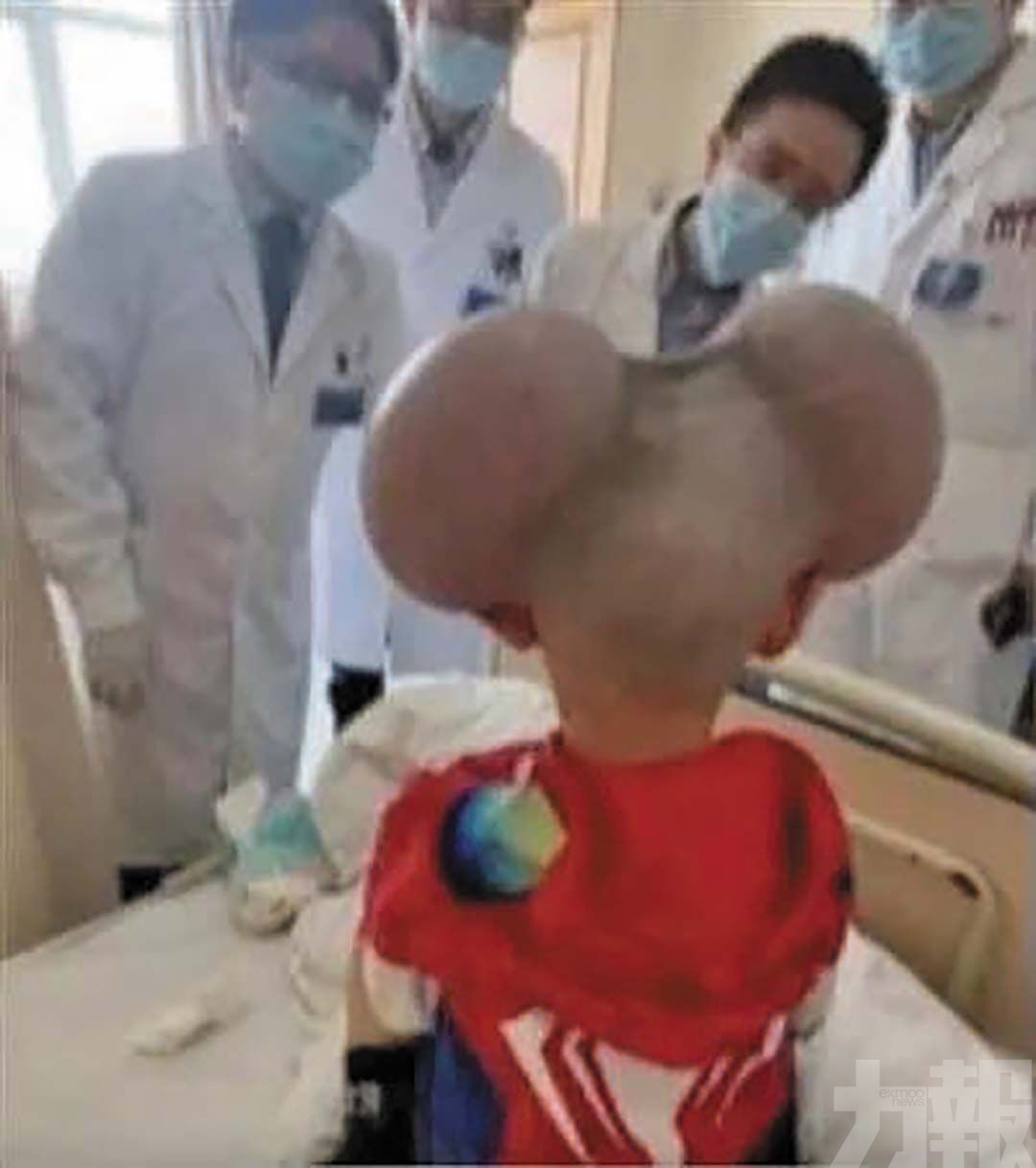 手術移除後終於笑了