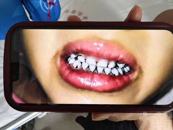 數十名學童鉛濃度超標