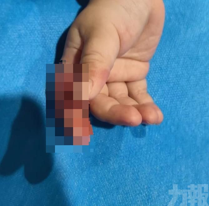 女嬰手指部分皮膚壞死險截肢