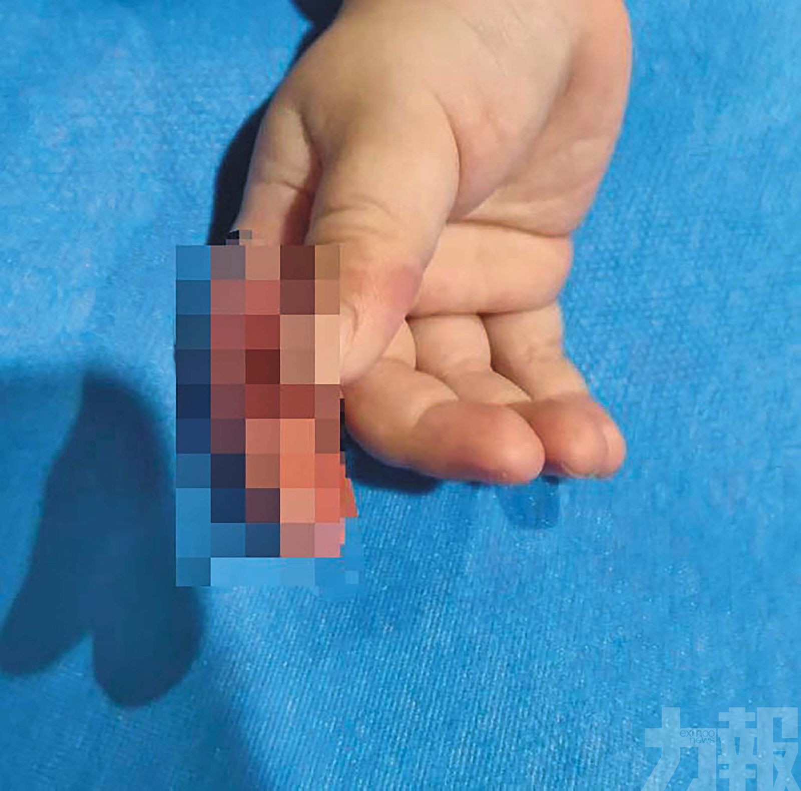 女嬰手指部分皮膚壞死險截肢