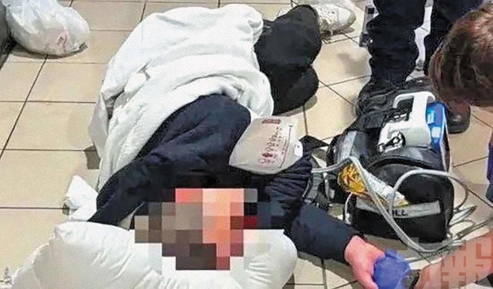 顱骨骨折搶救30小時脫險
