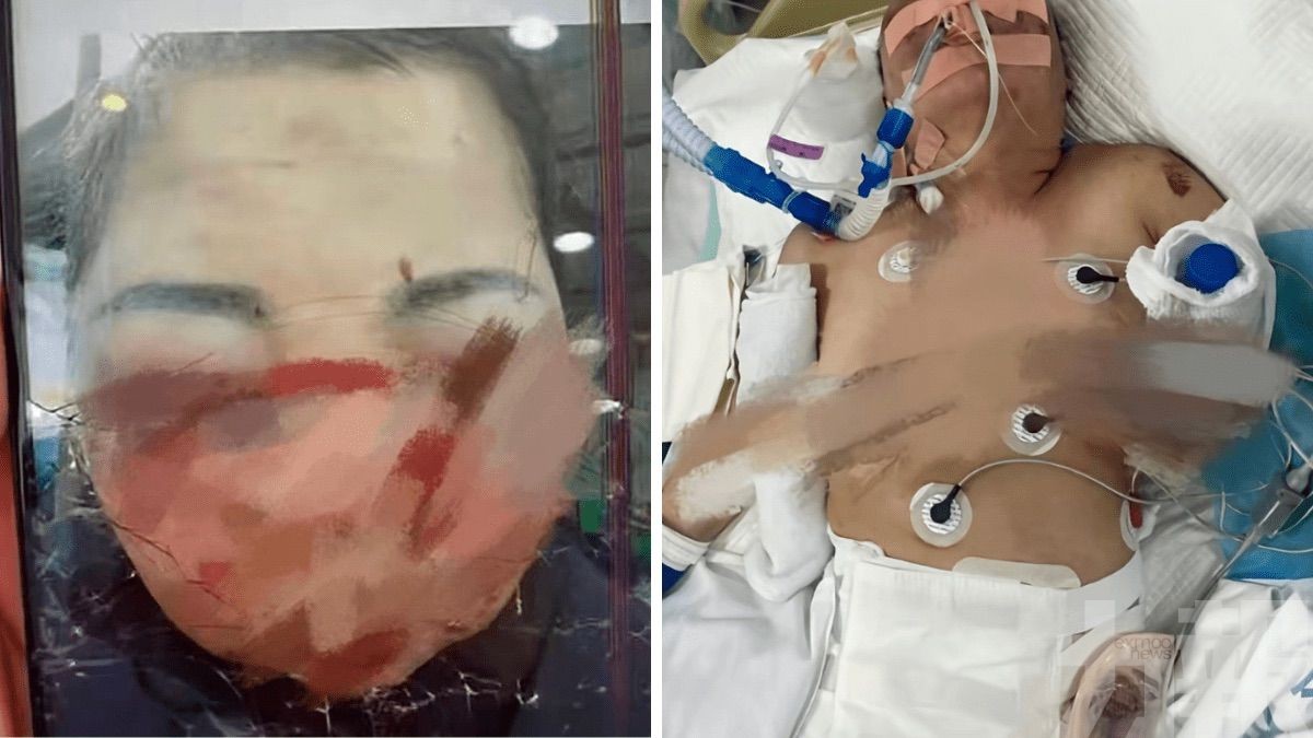 被打至直腸破裂臟器損傷身亡