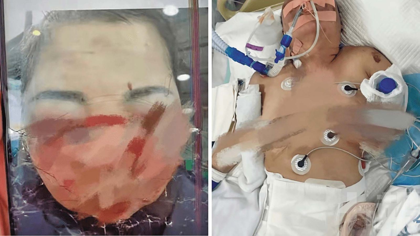 被打至直腸破裂臟器損傷身亡