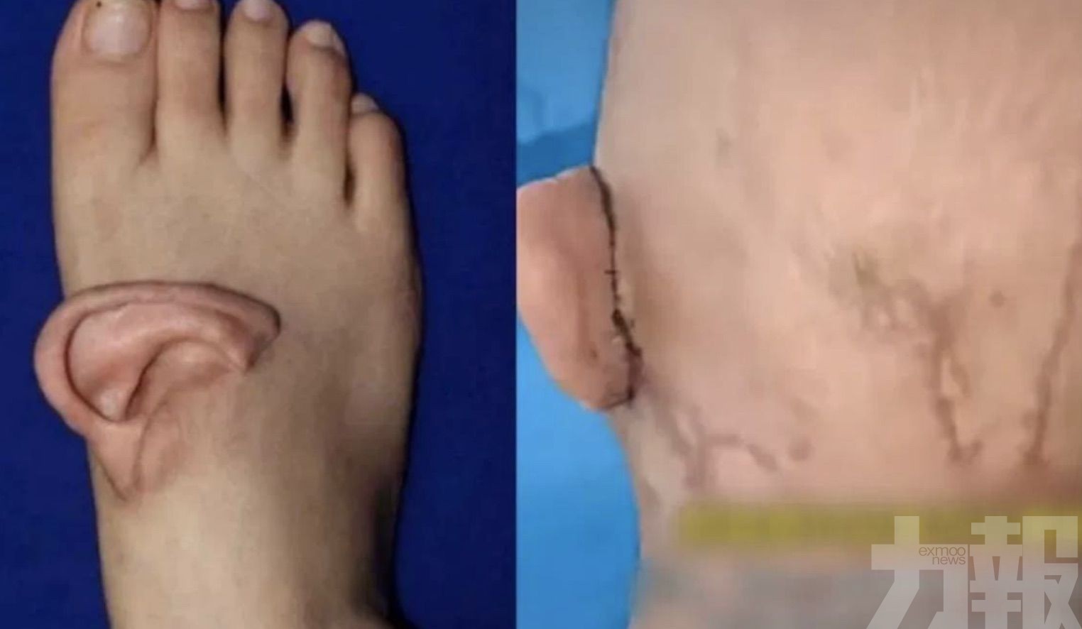 五個月後成功回植復位