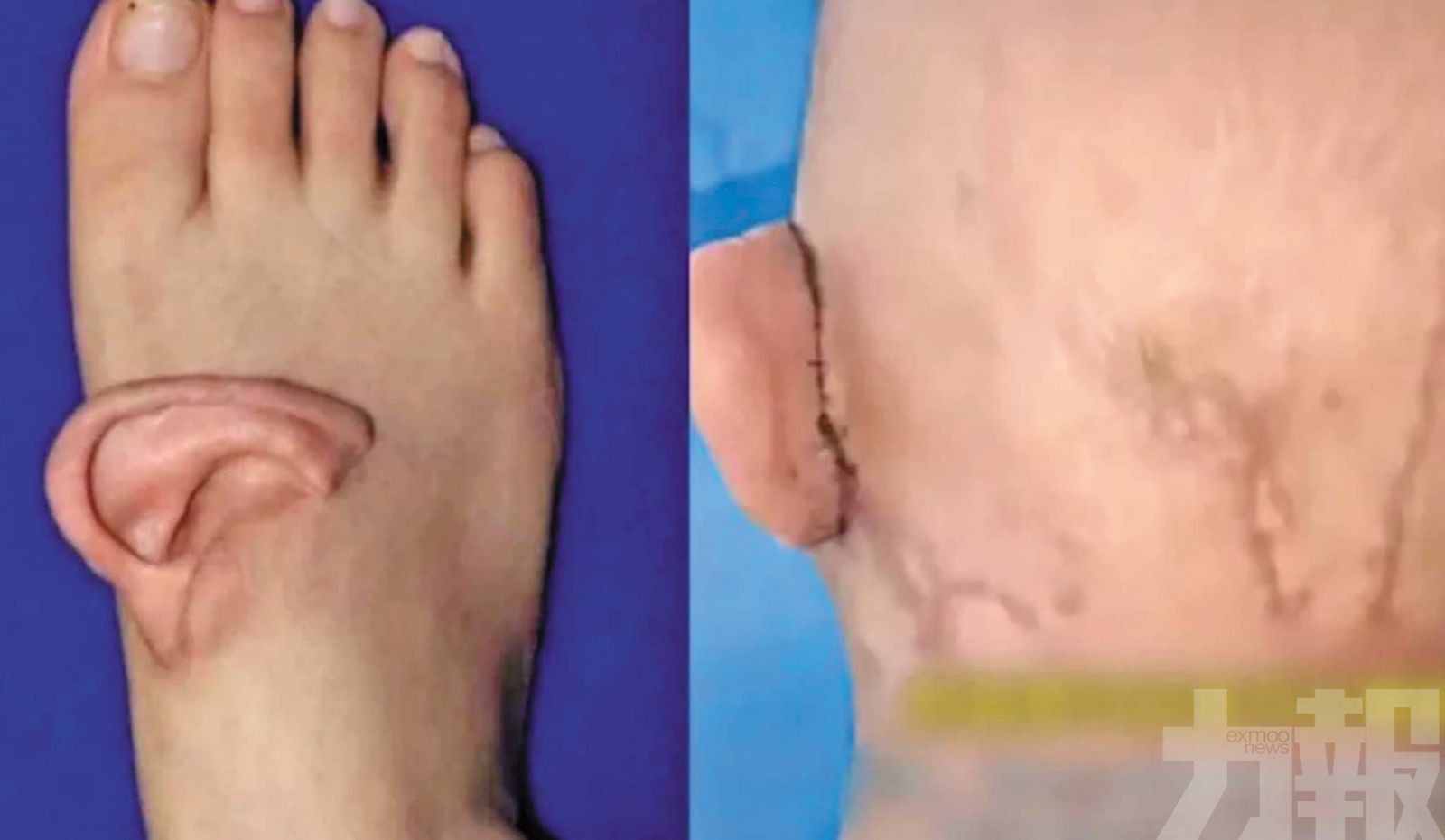 五個月後成功回植復位