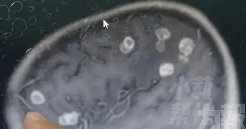 六歲女童腦部現20多個空洞