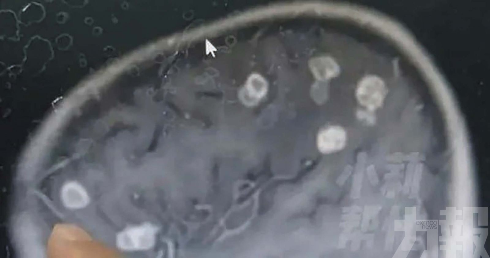 六歲女童腦部現20多個空洞