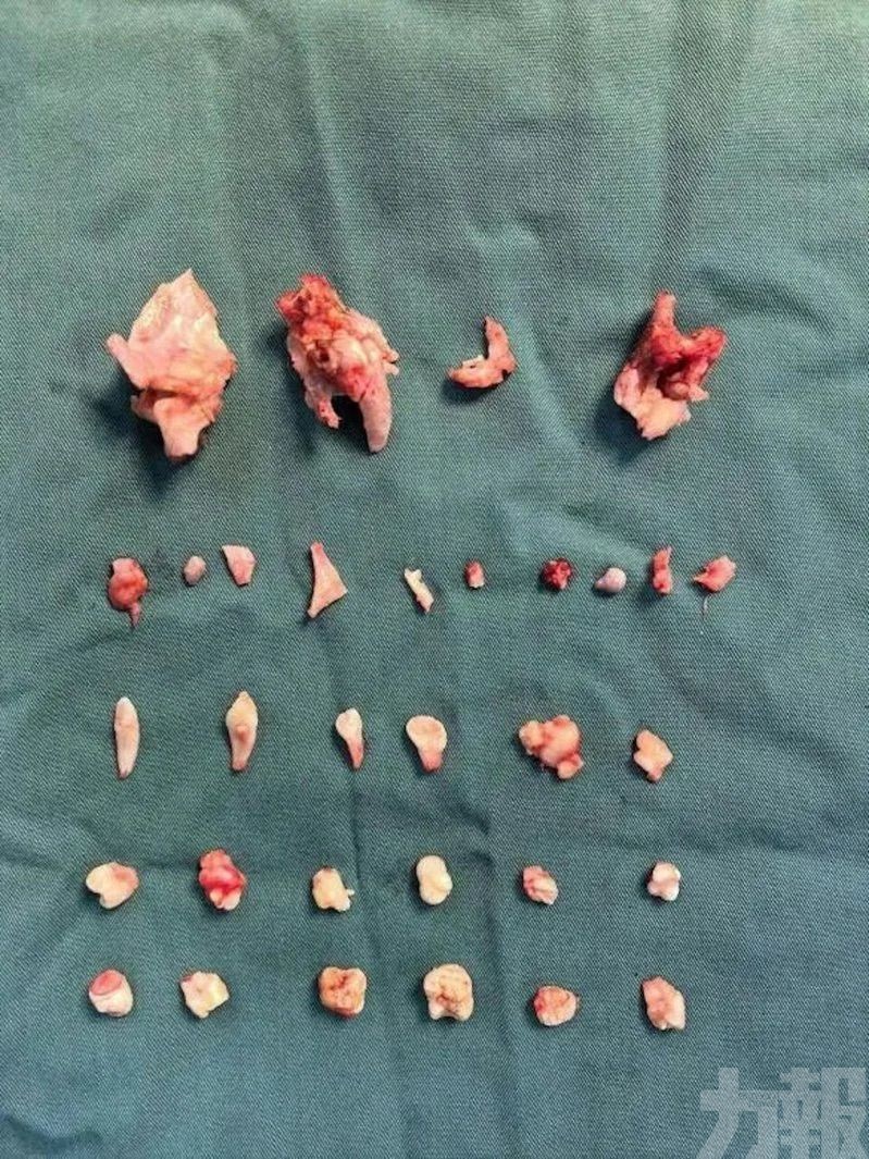 腹內畸胎瘤內藏24顆牙齒