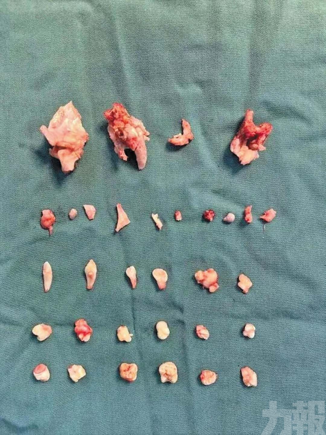 腹內畸胎瘤內藏24顆牙齒