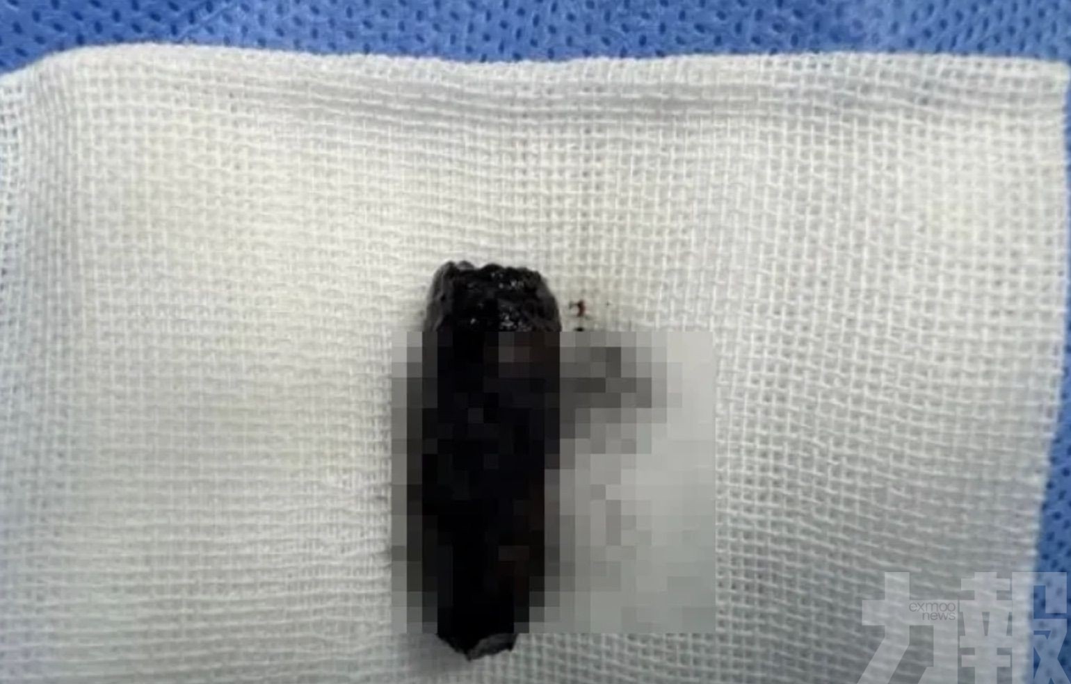 鼻腔取出藏40年螺絲