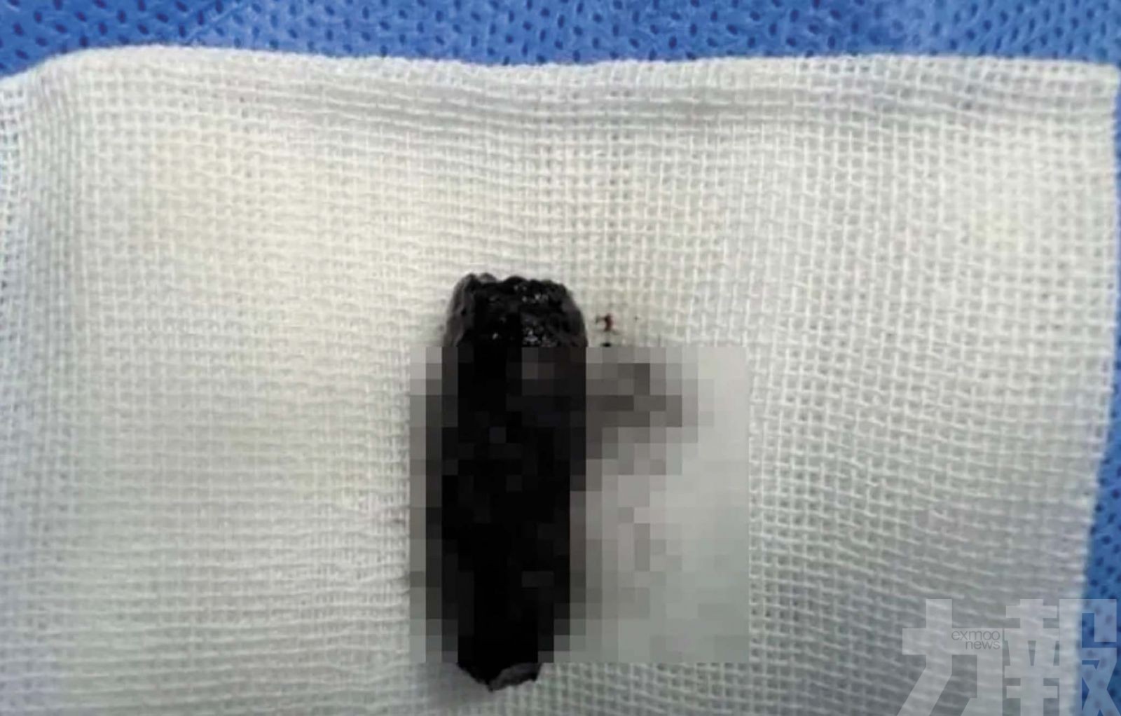 鼻腔取出藏40年螺絲