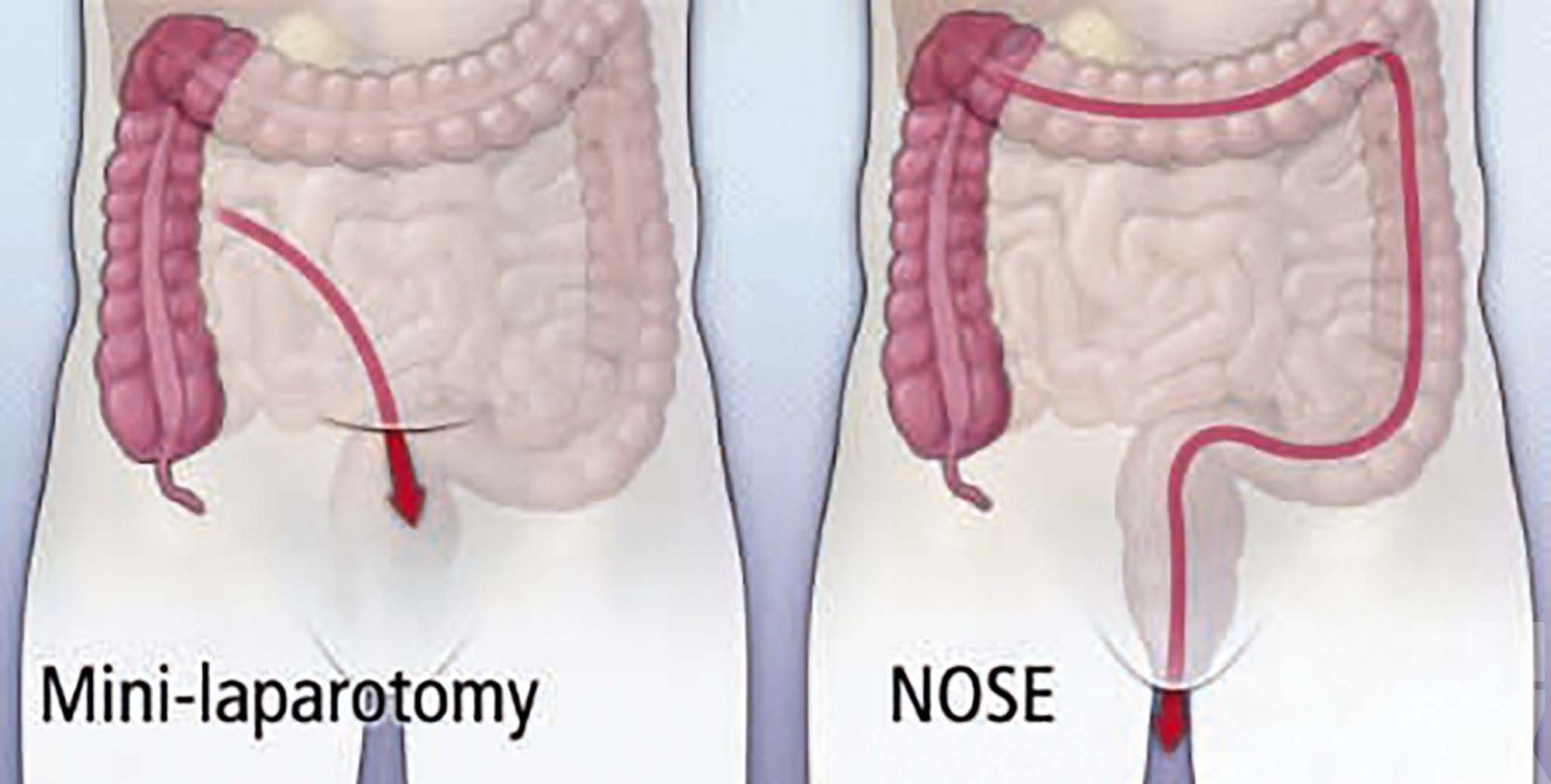 微微創根治術：不開腹根治三期腸癌