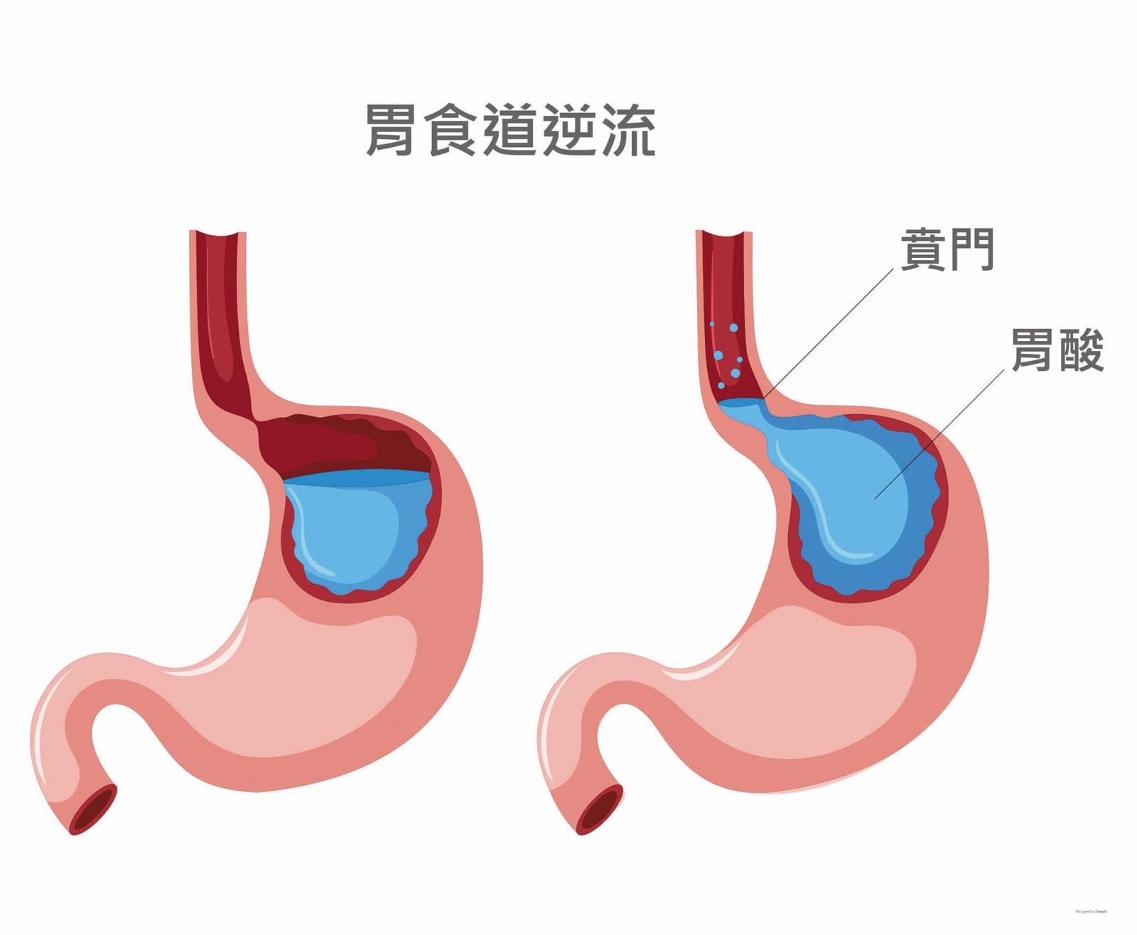 胃酸終結者 - 胃鏡抗返流術