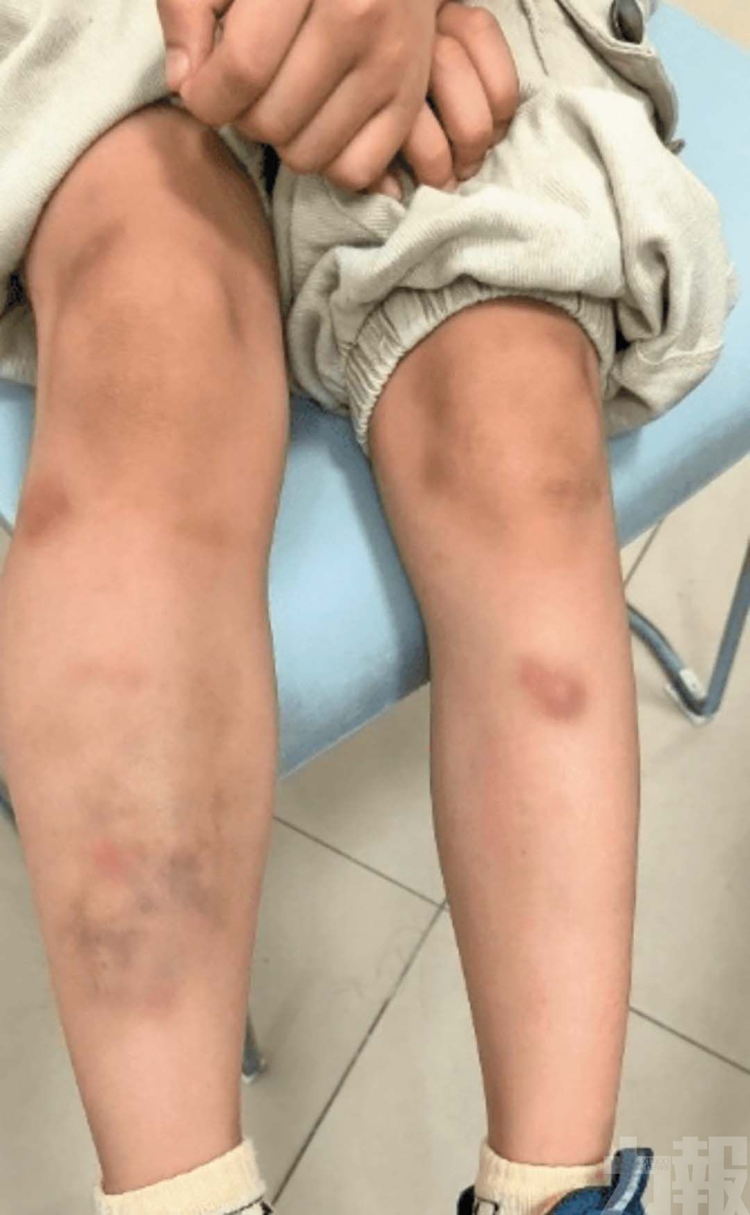 證實感染鈎蟲寄生蟲