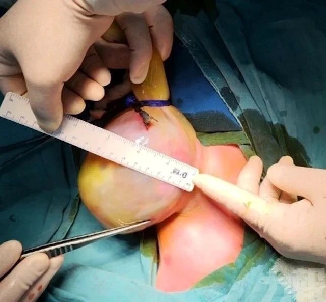 武漢醫生兩年分階段助器官歸位