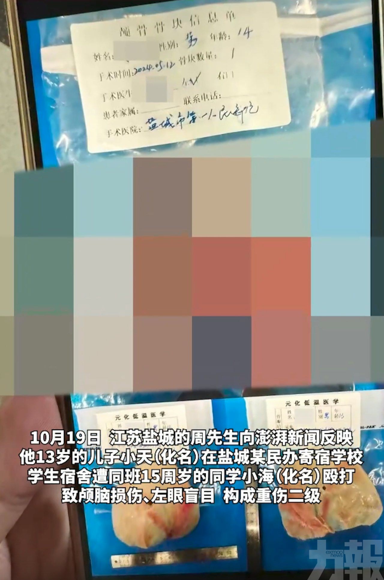 13歲學生遭同學圍毆偏癱失明