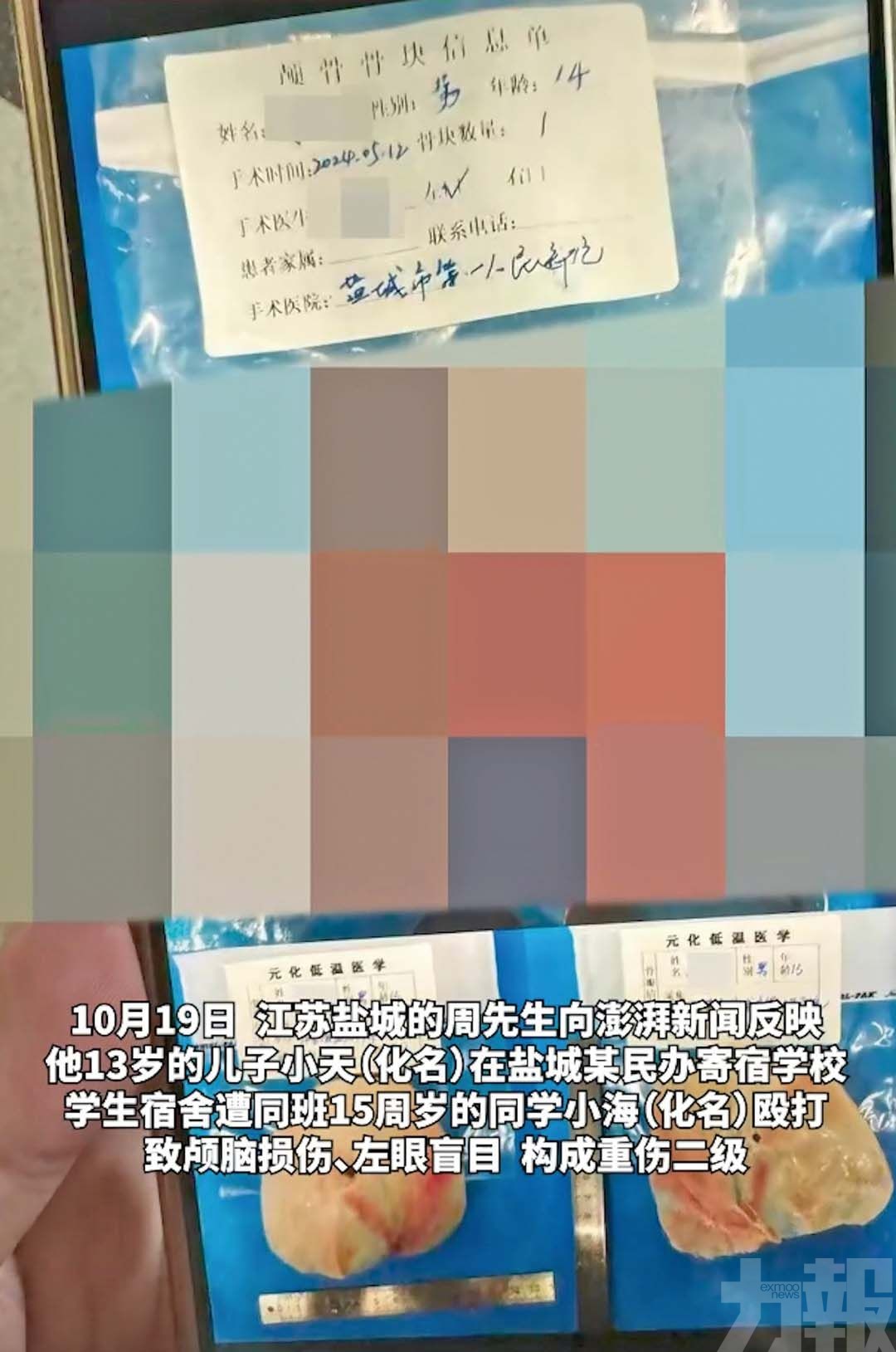 13歲學生遭同學圍毆偏癱失明