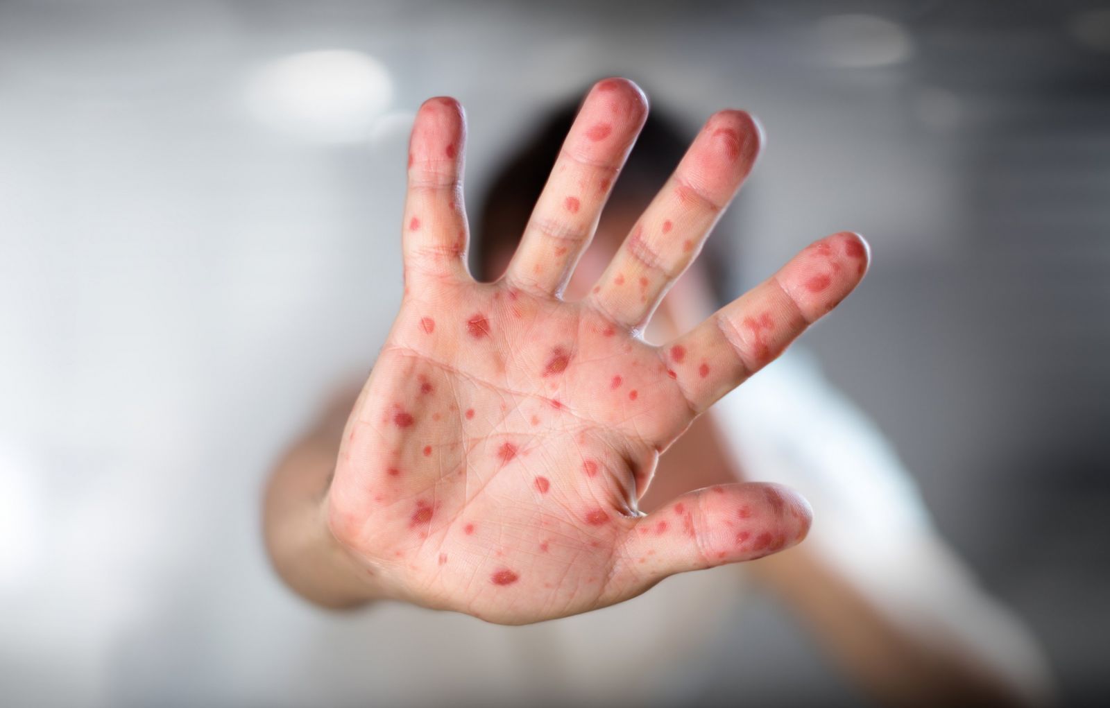 英國五地區爆麻疹疫情 逾百人感染
