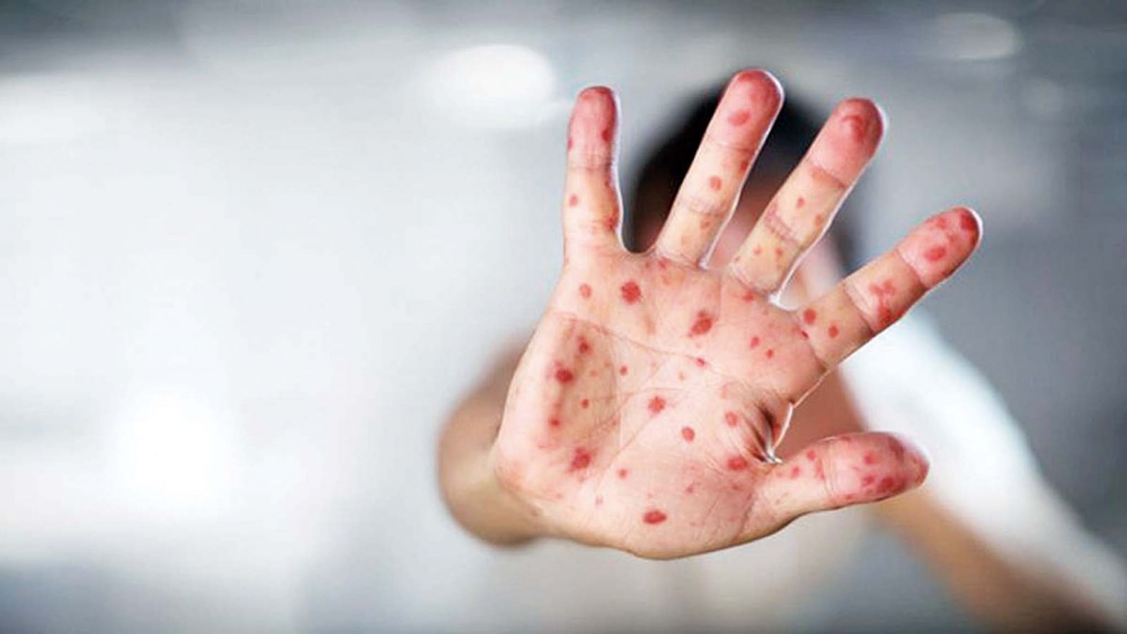指台人在澳感染麻疹可能性極微
