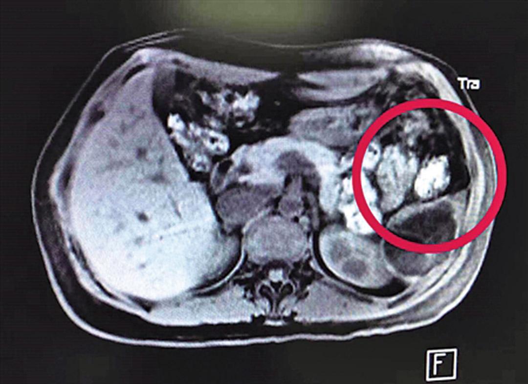 重慶孕婦脾臟育胎兒