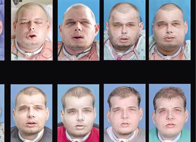 史上最強換臉手術 美毀容消防員換臉重生