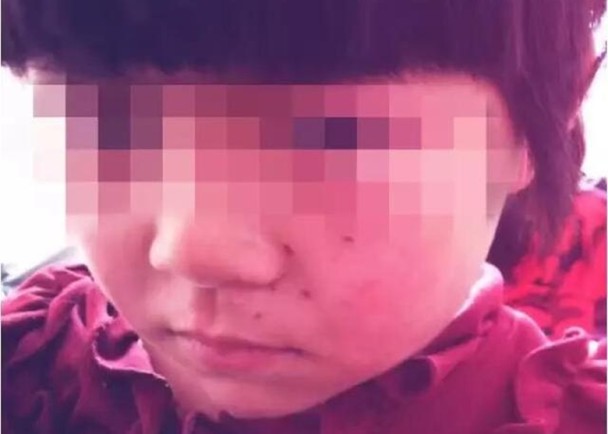 河南六歲女童遭老師鉛筆扎臉
