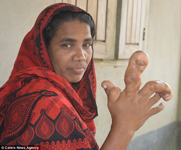 孟加拉婦手長水泡腫如足球