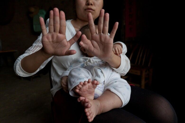 男嬰患多指症31隻手指腳趾