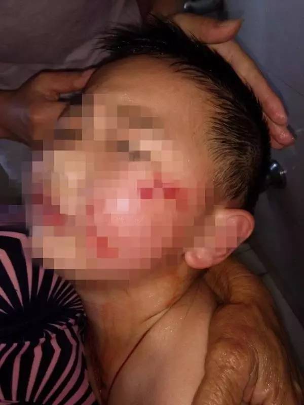 浙七歲童被咬左臉縫逾50針
