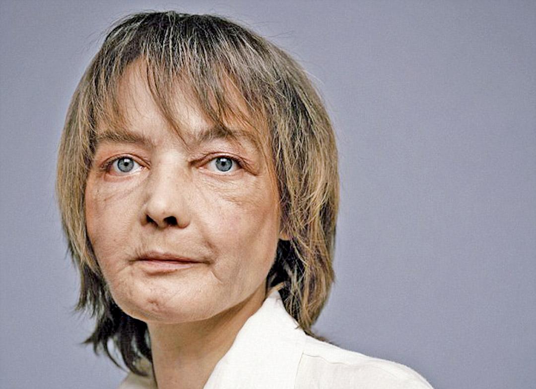 術後患雙癌存活11年