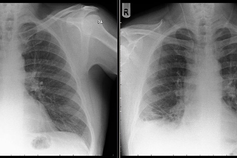 照X光竟發現肺部藏40年前玩具