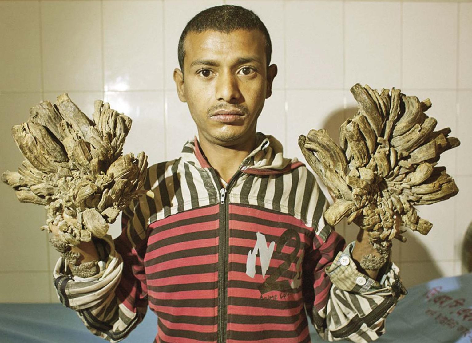 手腳長疣猶如樹根