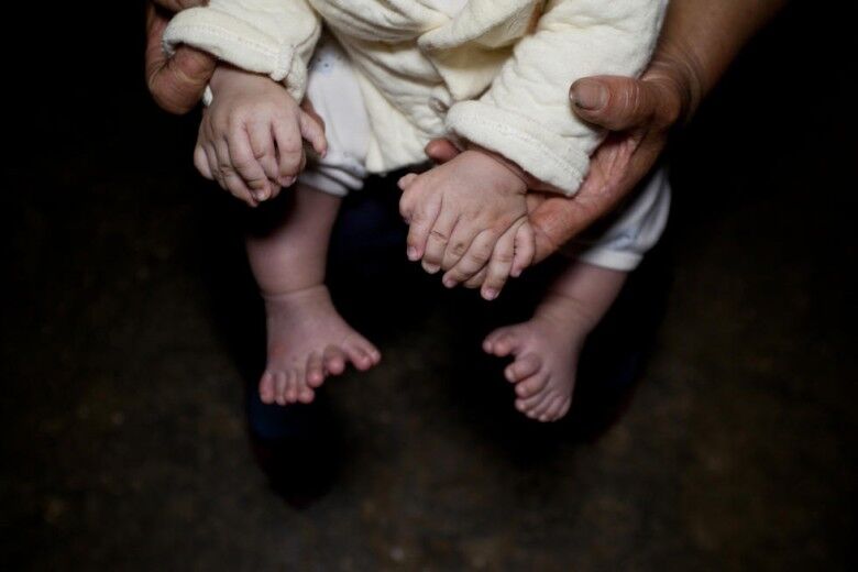 男嬰患多指症31隻手指腳趾