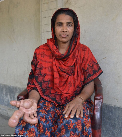 孟加拉婦手長水泡腫如足球