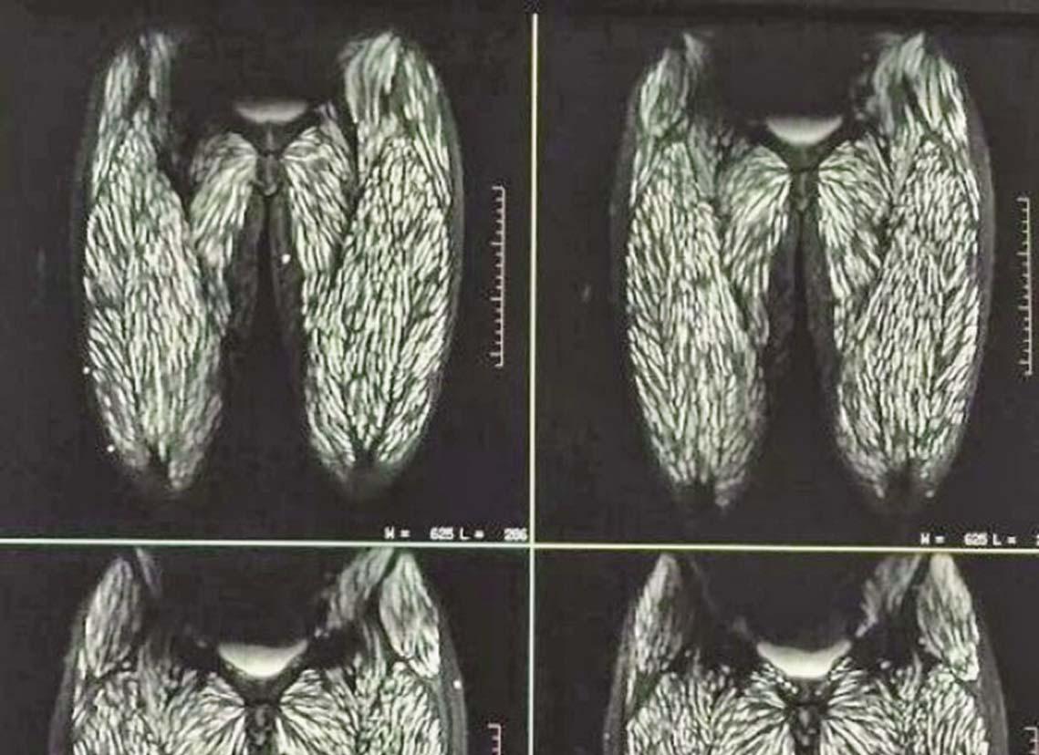 雲南女十歲起食生豬肉