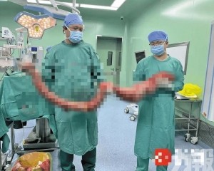 手術取出逾10公斤「巨蟒」 