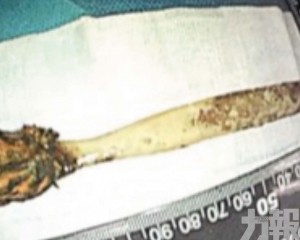 手術驚險取出塑膠異物