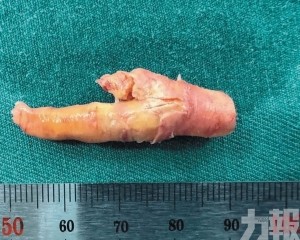血管取出「一隻鳳爪」