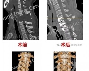 上海長征醫院團隊創醫學奇蹟