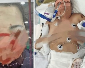 被打至直腸破裂臟器損傷身亡