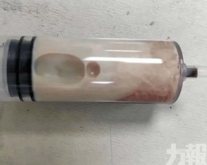 醫生從體內抽出「牛奶血」