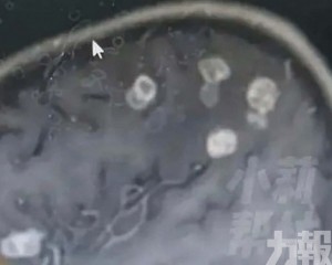 六歲女童腦部現20多個空洞