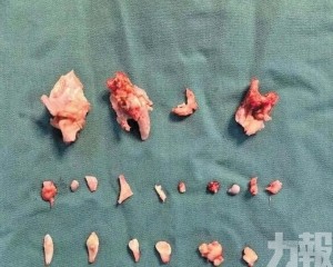 腹內畸胎瘤內藏24顆牙齒
